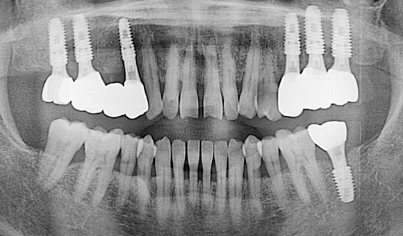 X-RAY 치료 후