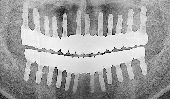 X-RAY 치료 후