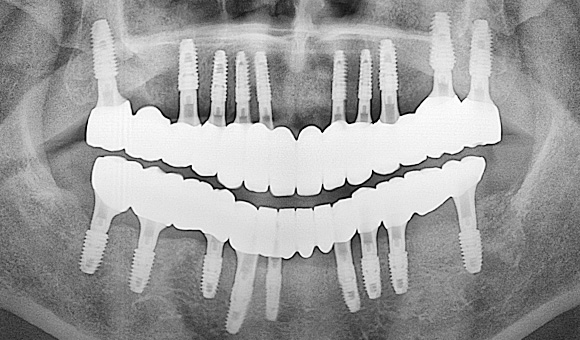X-RAY 치료 후