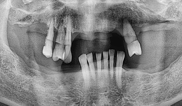X-RAY 치료 전