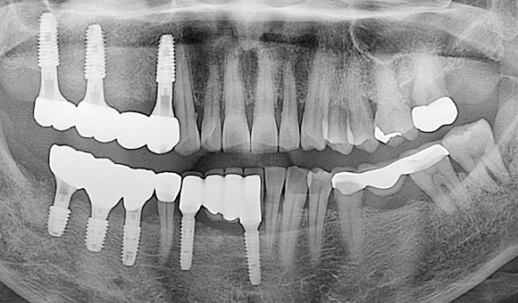 X-RAY 치료 후