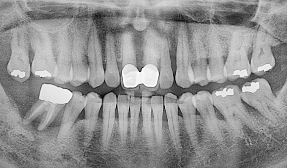 X-RAY 치료 전
