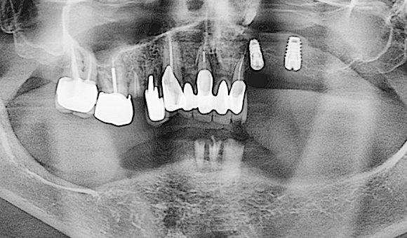 X-RAY 치료 전