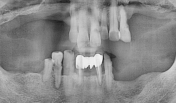 X-RAY 치료 전